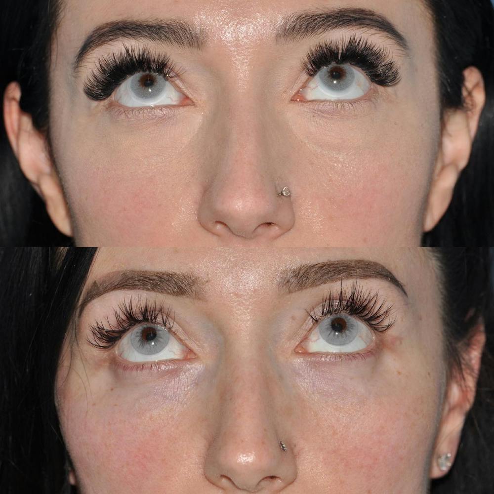Blepharoplasty Before & After Gallery - Patient 58470294 - Image 3