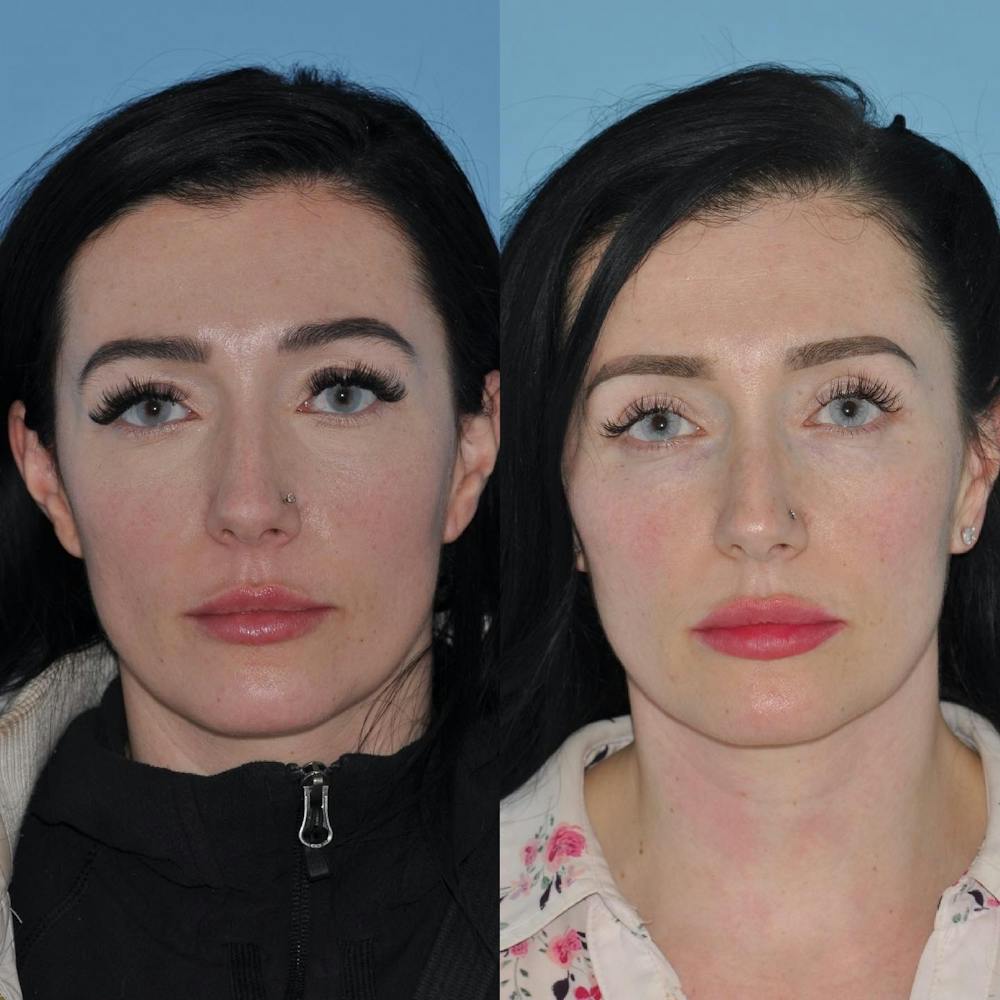 Blepharoplasty Before & After Gallery - Patient 58470294 - Image 4