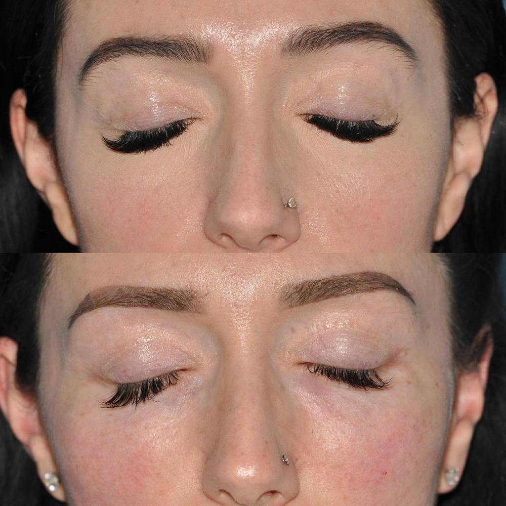 Blepharoplasty Before & After Gallery - Patient 58470294 - Image 5