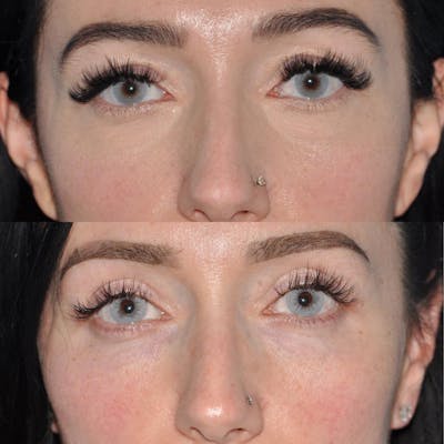 Blepharoplasty Before & After Gallery - Patient 58470294 - Image 6