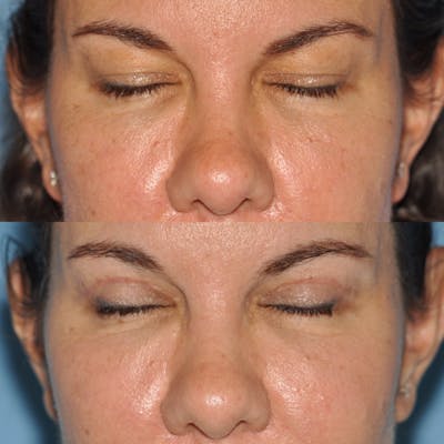 Blepharoplasty Before & After Gallery - Patient 58470296 - Image 2