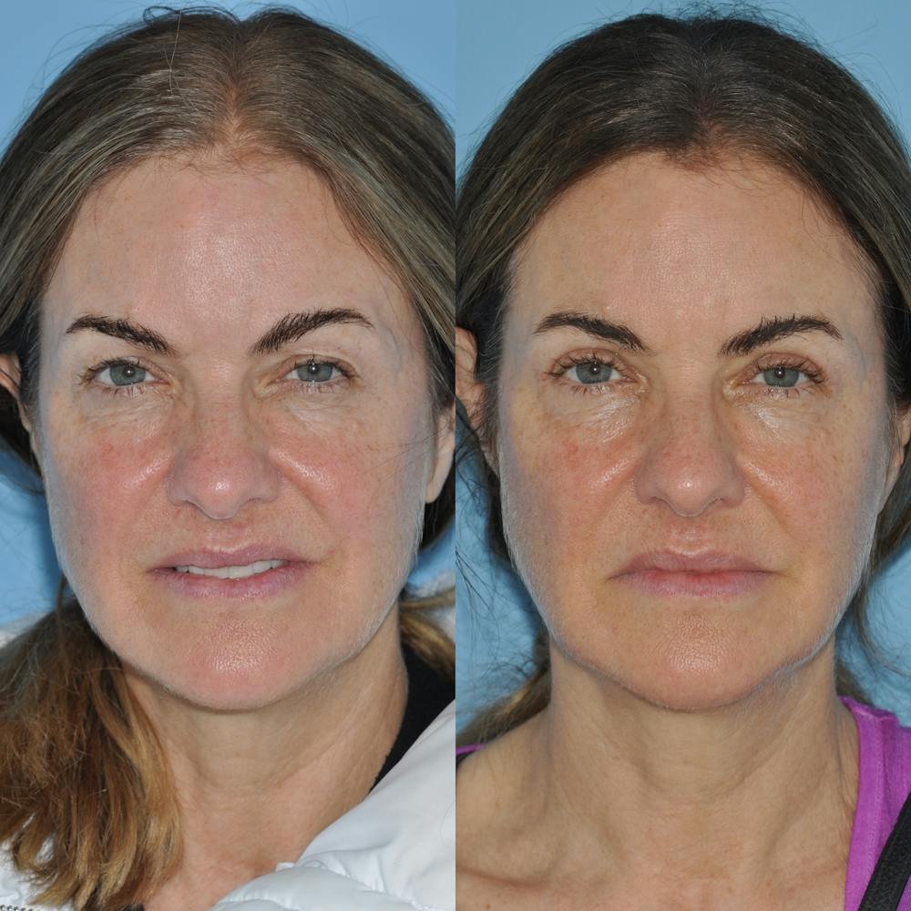 Blepharoplasty Before & After Gallery - Patient 58470297 - Image 1