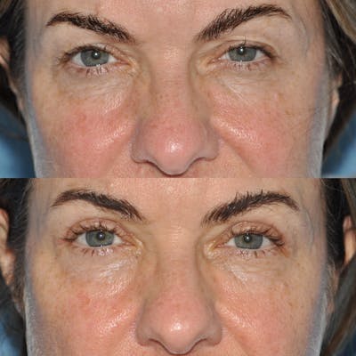 Blepharoplasty Before & After Gallery - Patient 58470297 - Image 2