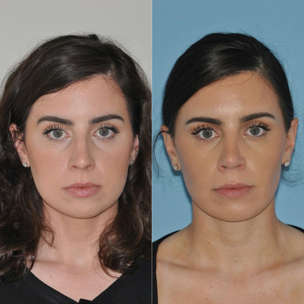 Buccal Fat Excision Before & After Gallery - Patient 58470298 - Image 3