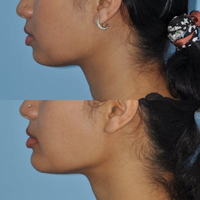 Chin Implants Gallery - Patient 58470335 - Image 2