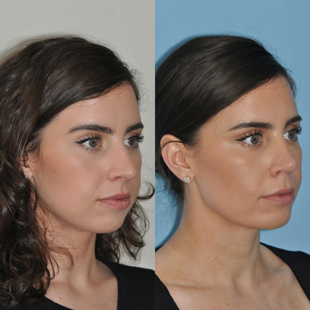 Chin Implants Before & After Gallery - Patient 58470336 - Image 3