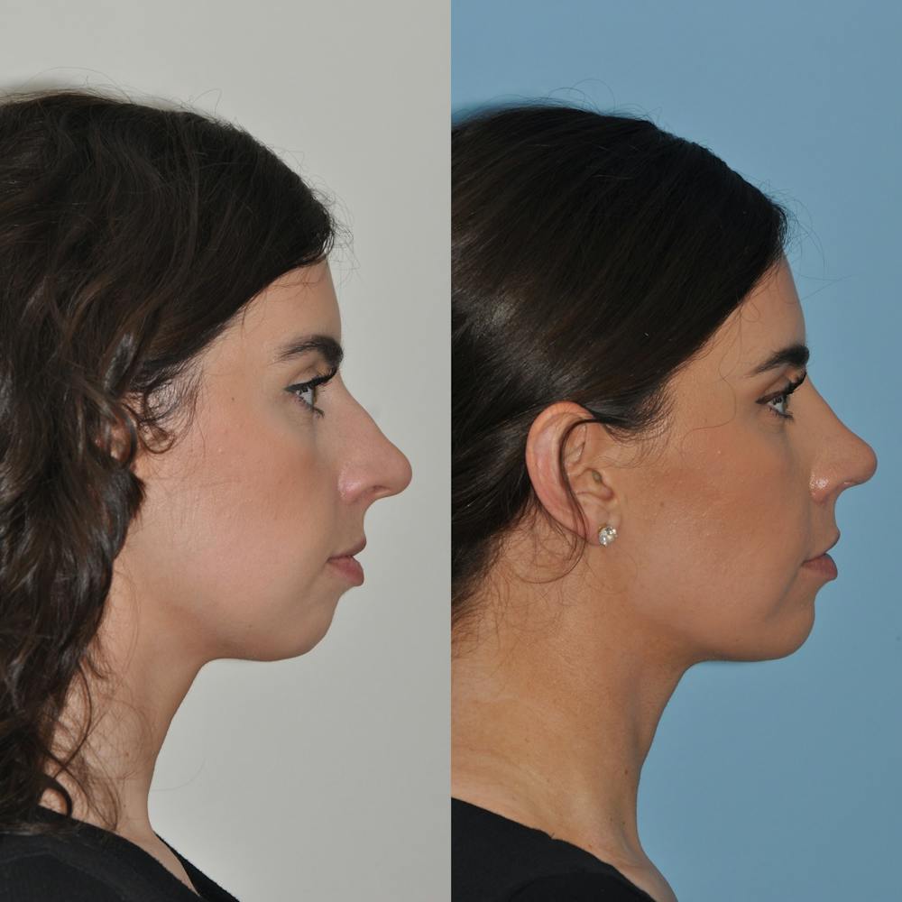Chin Implants Before & After Gallery - Patient 58470336 - Image 4