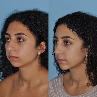 Chin Implants Before & After Gallery - Patient 58470337 - Image 1