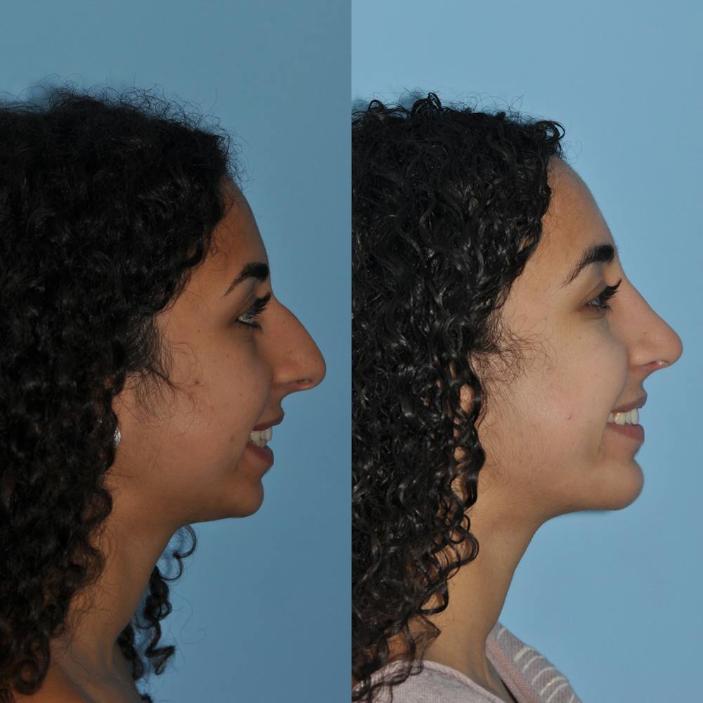 Chin Implants Before & After Gallery - Patient 58470337 - Image 2