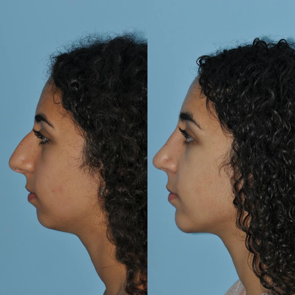 Chin Implants Before & After Gallery - Patient 58470337 - Image 3