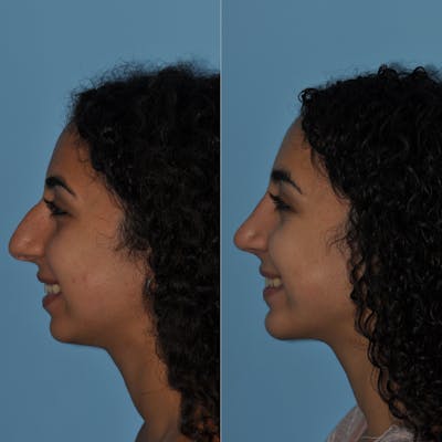 Chin Implants Before & After Gallery - Patient 58470337 - Image 4