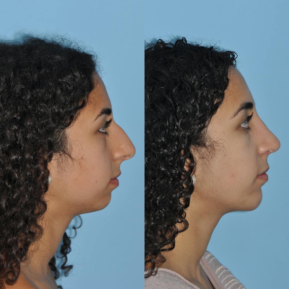 Chin Implants Before & After Gallery - Patient 58470337 - Image 5