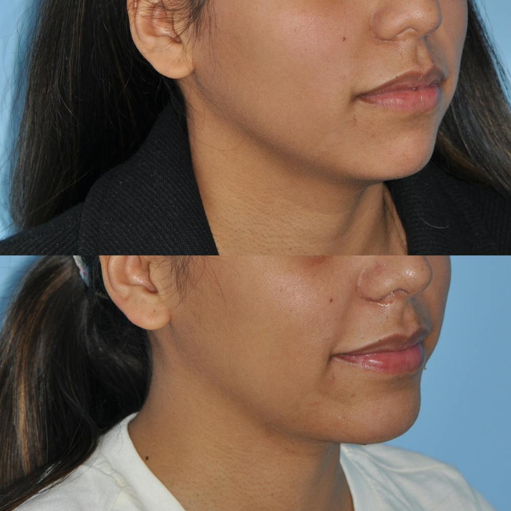 Chin Implants Before & After Gallery - Patient 58470338 - Image 1