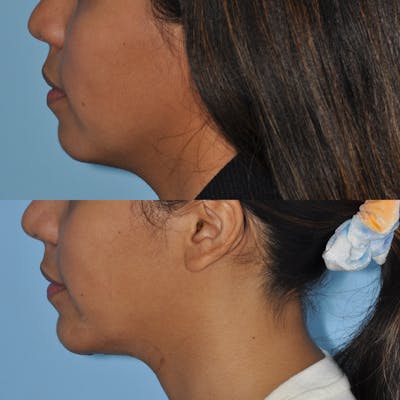 Chin Implants Before & After Gallery - Patient 58470338 - Image 2