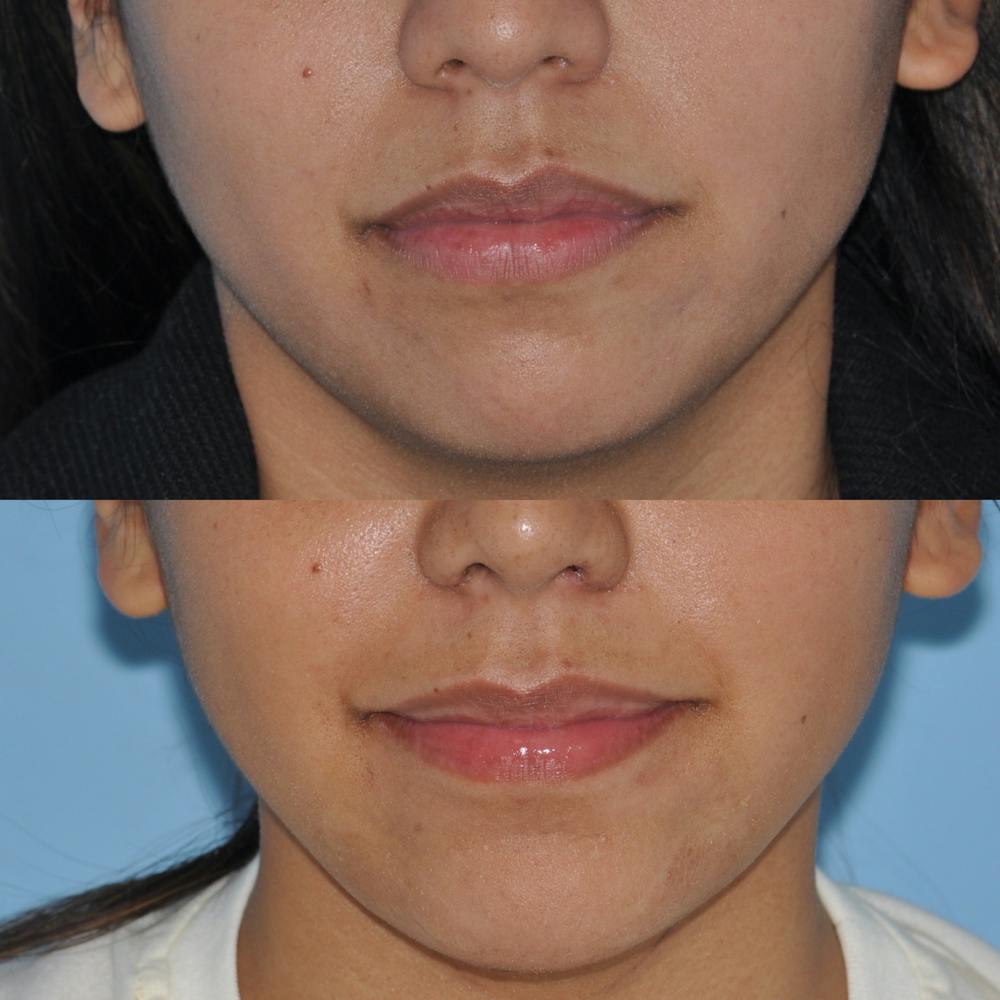 Chin Implants Before & After Gallery - Patient 58470338 - Image 3