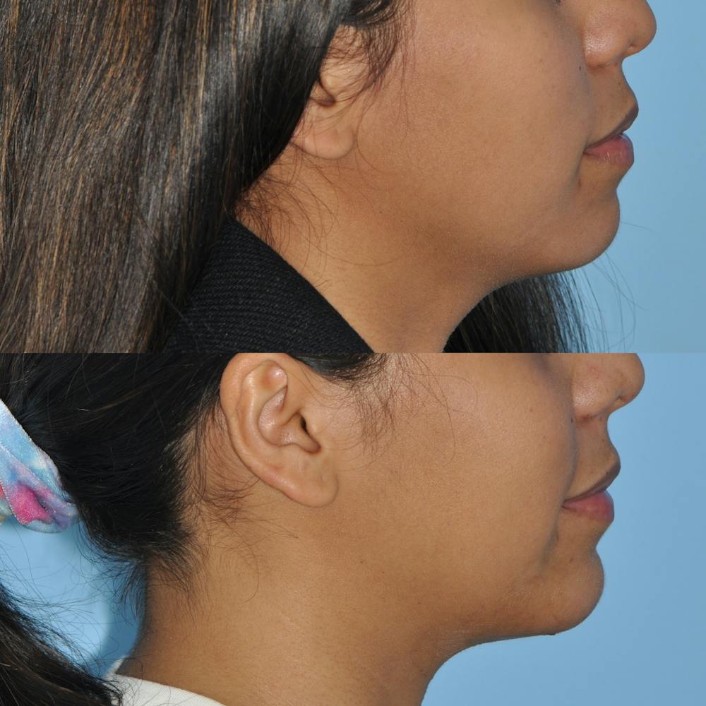 Chin Implants Before & After Gallery - Patient 58470338 - Image 4