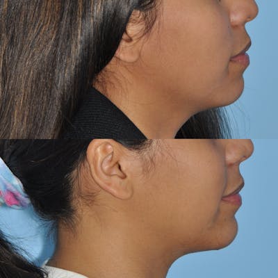 Chin Implants Before & After Gallery - Patient 58470338 - Image 4