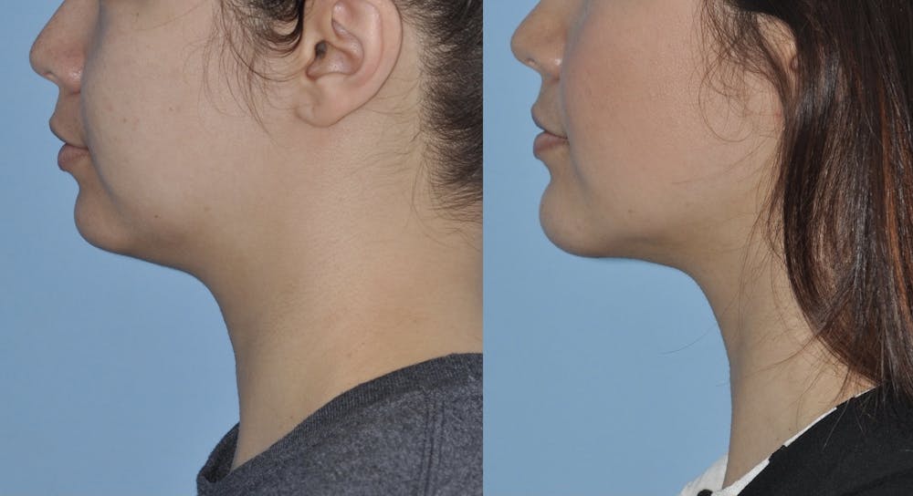 Chin Implants Gallery - Patient 58470339 - Image 2