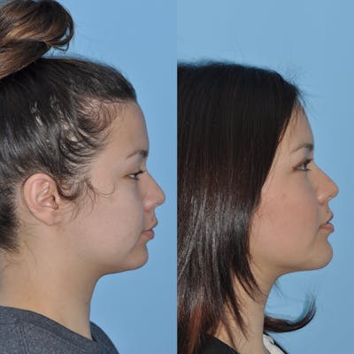 Chin Implants Before & After Gallery - Patient 58470339 - Image 4