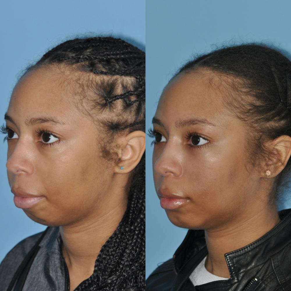 Chin Implants Before & After Gallery - Patient 58470340 - Image 1