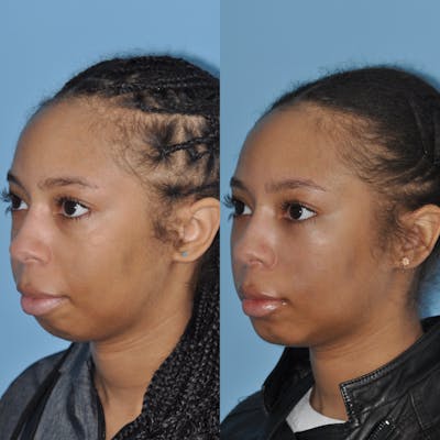 Chin Implants Before & After Gallery - Patient 58470340 - Image 1