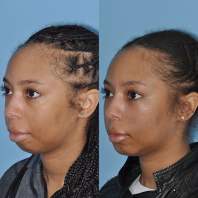 Chin Implants Gallery - Patient 58470340 - Image 1