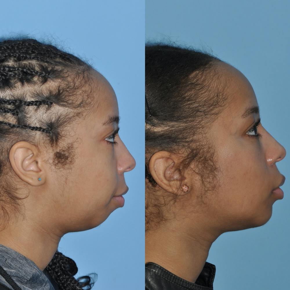 Chin Implants Before & After Gallery - Patient 58470340 - Image 2