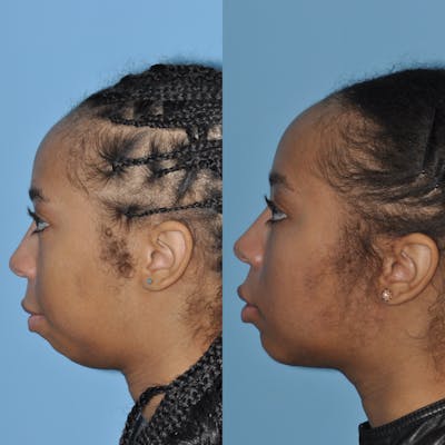 Chin Implants Before & After Gallery - Patient 58470340 - Image 1