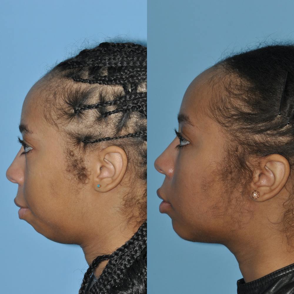 Chin Implants Before & After Gallery - Patient 58470340 - Image 3