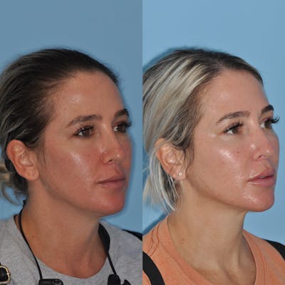 Neck Liposuction Before & After Gallery - Patient 58470346 - Image 2