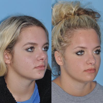 Revision Rhinoplasty Before & After Gallery - Patient 58470356 - Image 1