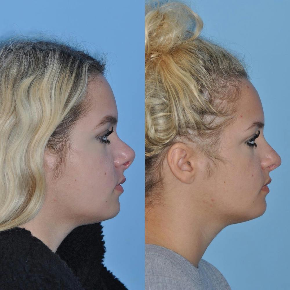 Revision Rhinoplasty Before & After Gallery - Patient 58470356 - Image 3