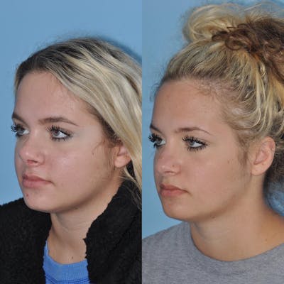 Revision Rhinoplasty Before & After Gallery - Patient 58470356 - Image 4