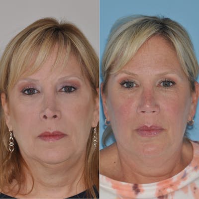 Revision Rhinoplasty Before & After Gallery - Patient 58470357 - Image 1