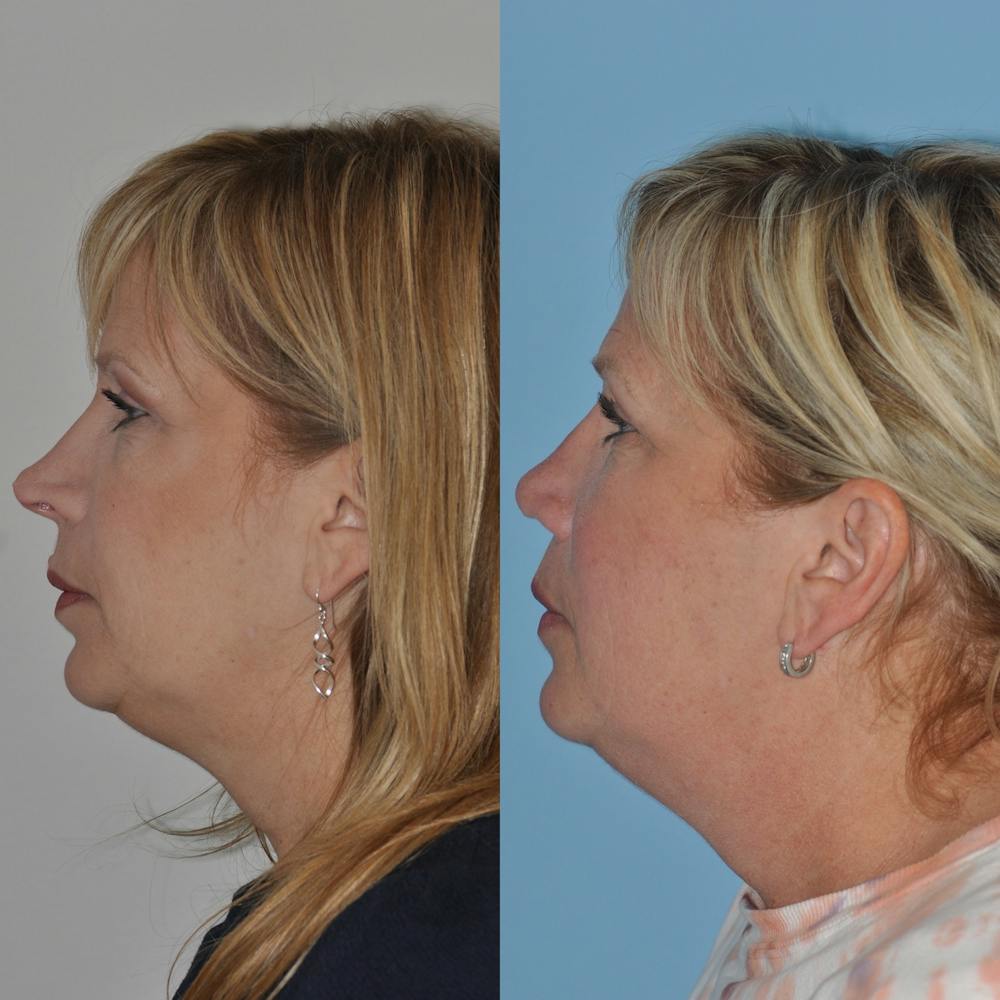 Revision Rhinoplasty Before & After Gallery - Patient 58470357 - Image 2