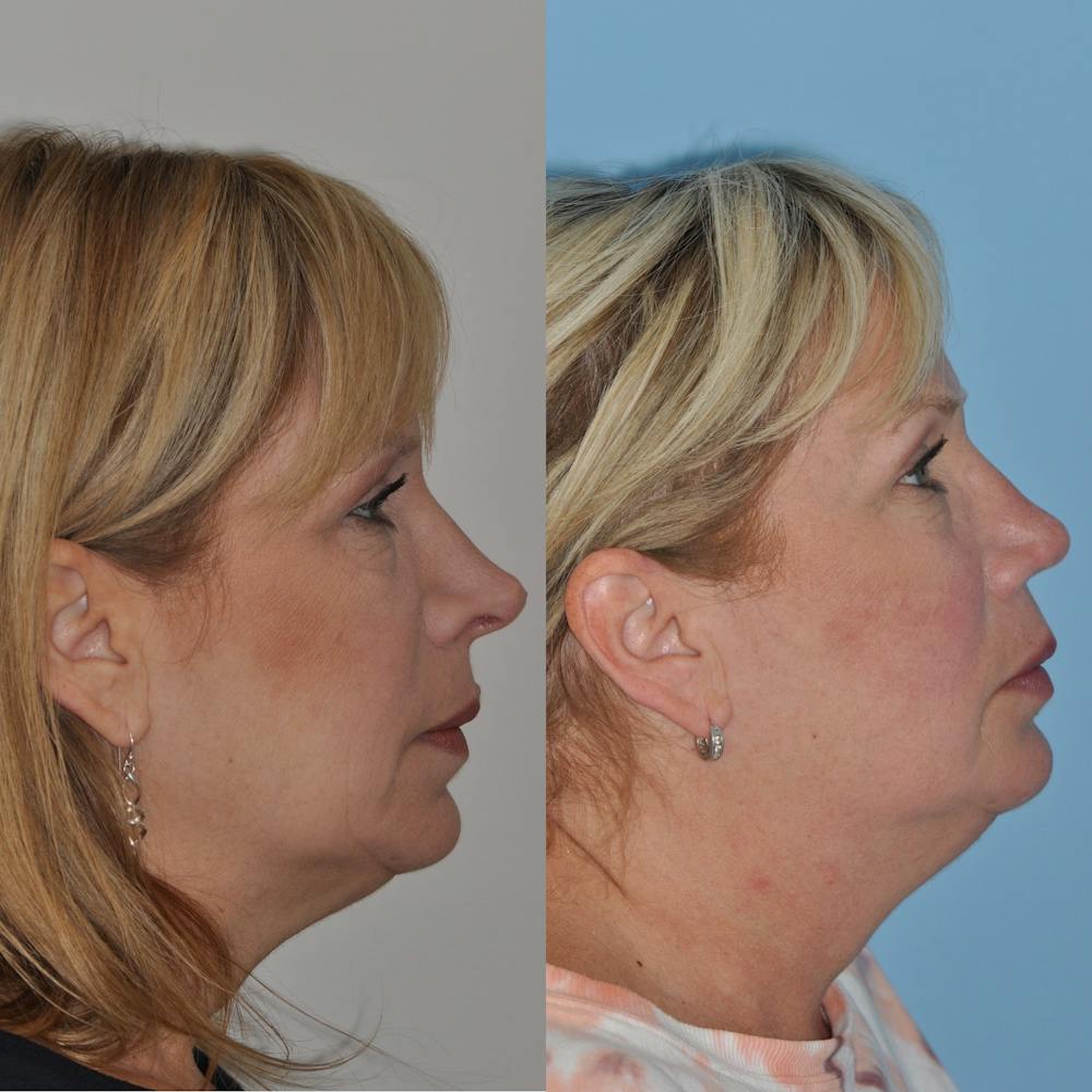 Revision Rhinoplasty Before & After Gallery - Patient 58470357 - Image 3