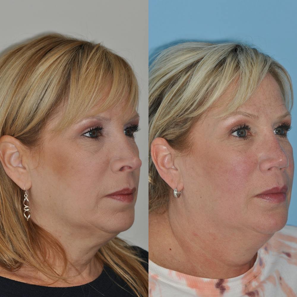 Revision Rhinoplasty Gallery - Patient 58470357 - Image 4