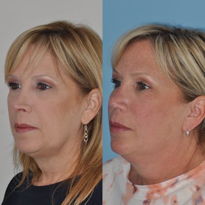 Revision Rhinoplasty Before & After Gallery - Patient 58470357 - Image 6