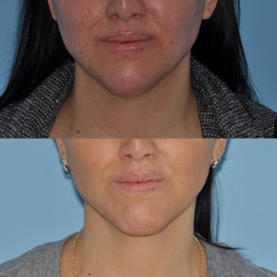 ThermiRF Before & After Gallery - Patient 58470363 - Image 1