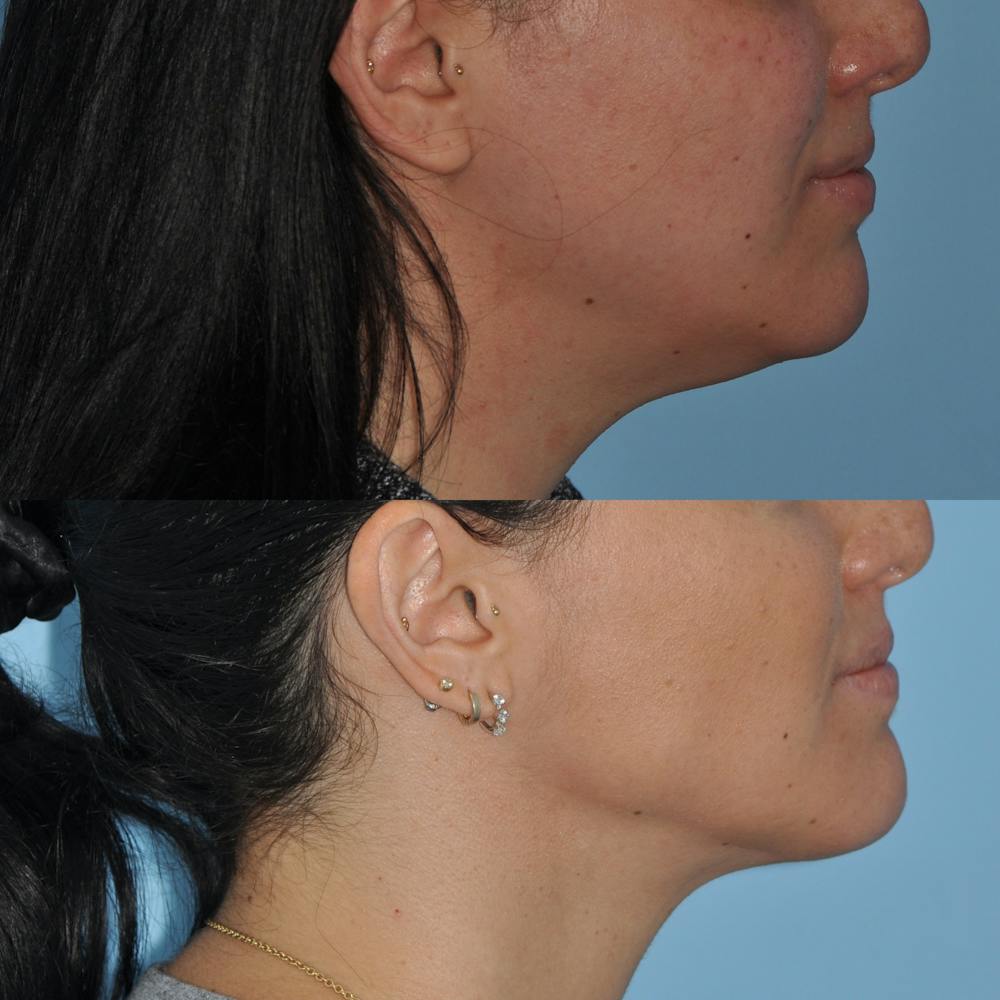 ThermiRF Before & After Gallery - Patient 58470363 - Image 3