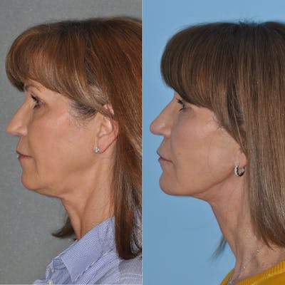 Facelift Before & After Gallery - Patient 59047930 - Image 4