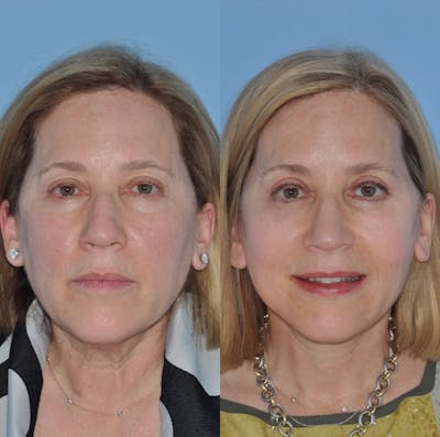 Facelift Before & After Gallery - Patient 59047933 - Image 1