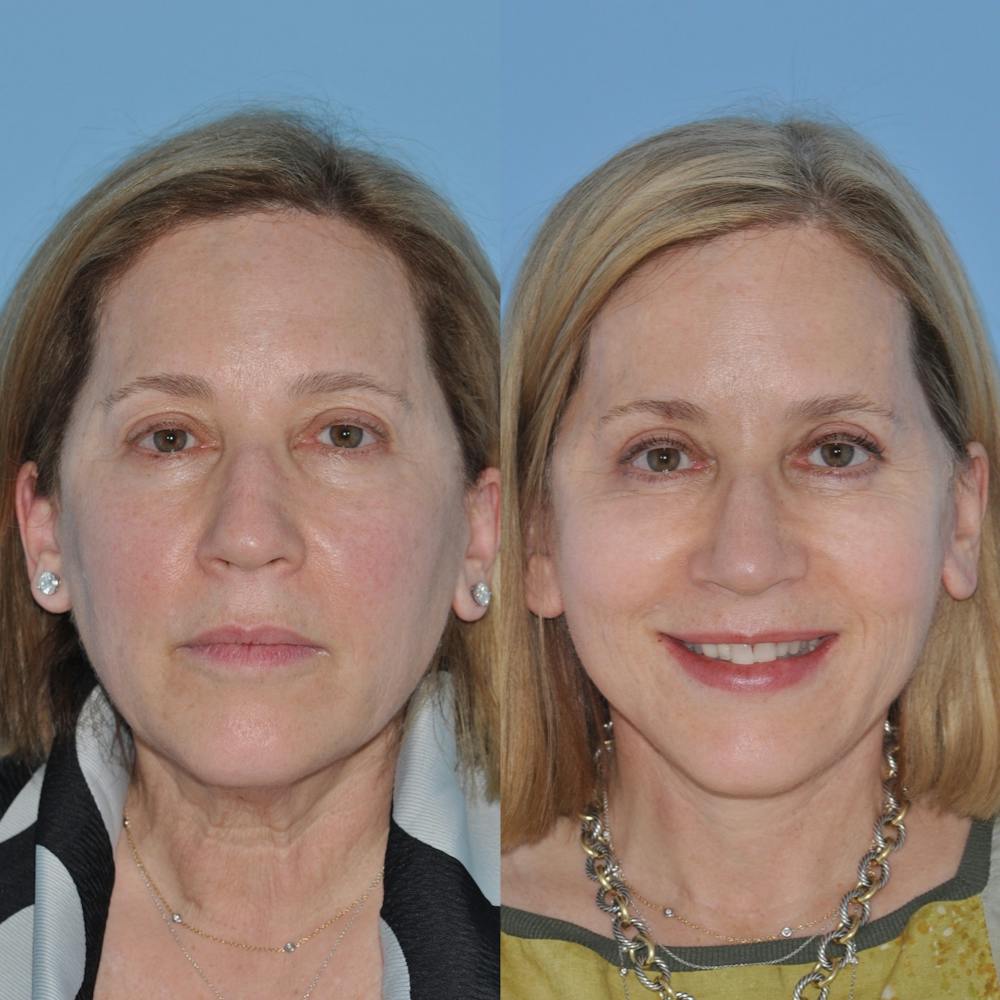 Facelift Before & After Gallery - Patient 59047933 - Image 5