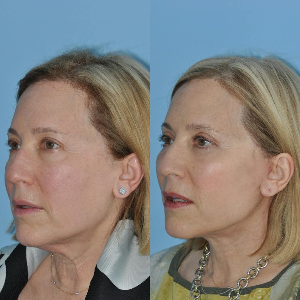 Facelift Before & After Gallery - Patient 59047933 - Image 6