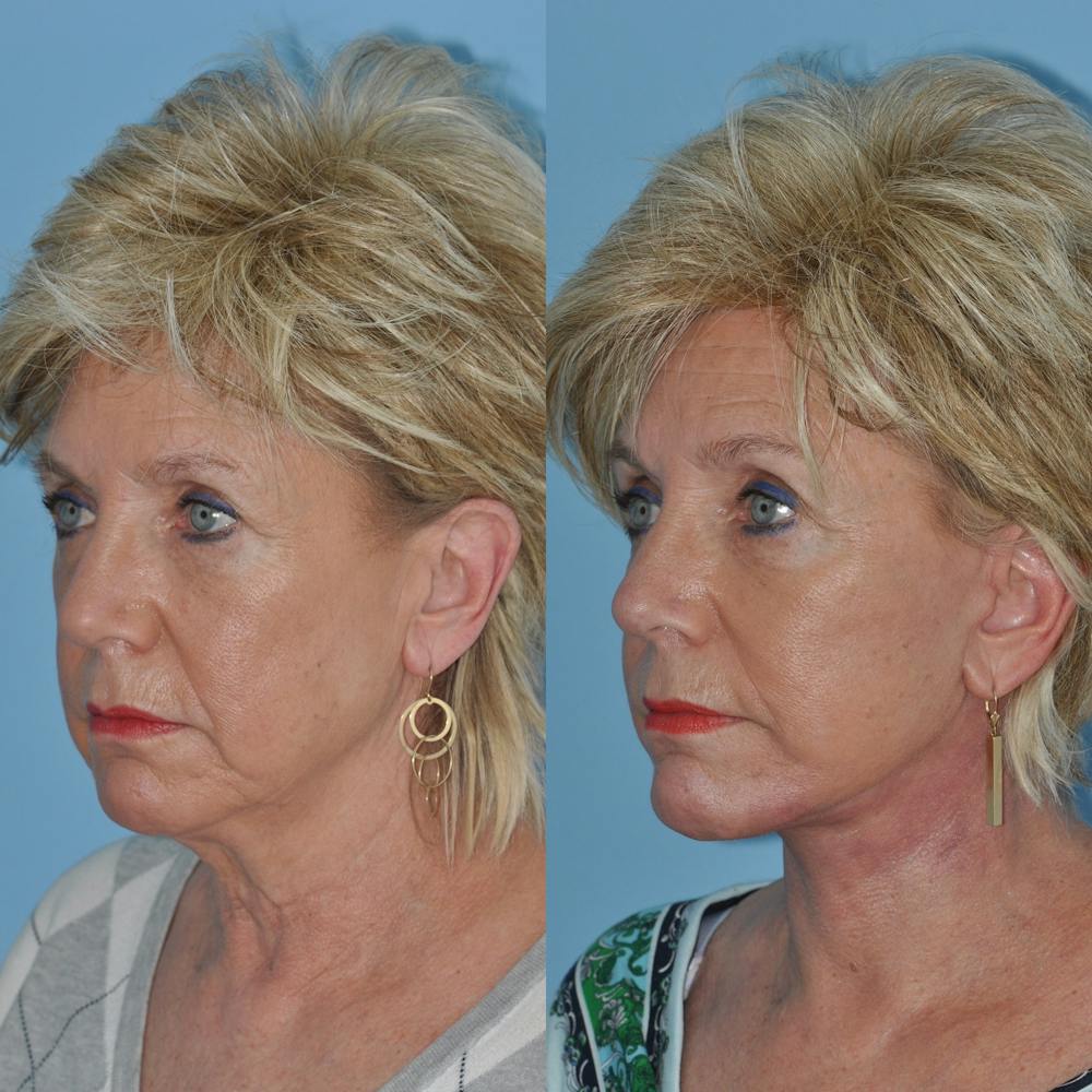 Facelift Before & After Gallery - Patient 59047937 - Image 3