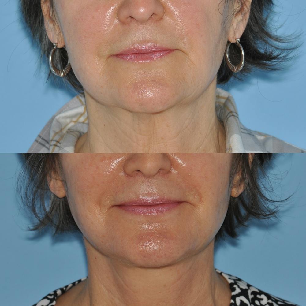 Facelift Before & After Gallery - Patient 59047938 - Image 3
