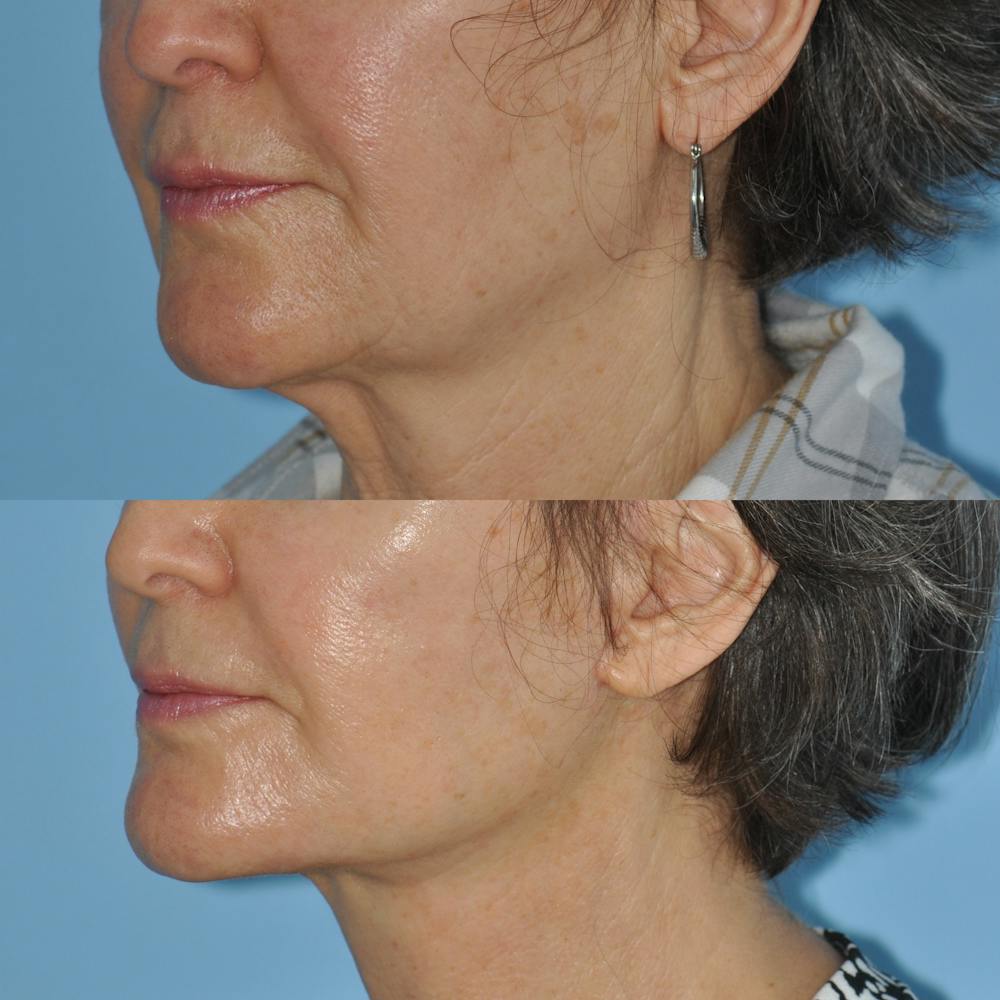 Facelift Before & After Gallery - Patient 59047938 - Image 4