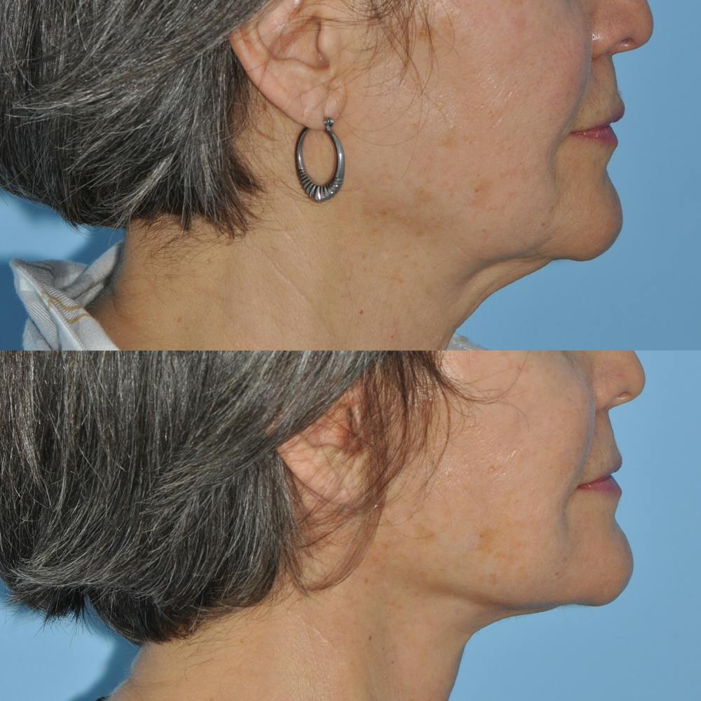 Facelift Before & After Gallery - Patient 59047938 - Image 5
