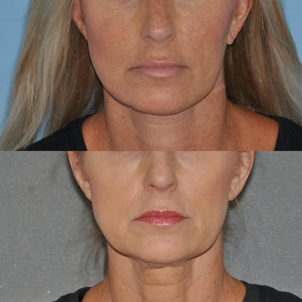 Facelift Before & After Gallery - Patient 59047940 - Image 1