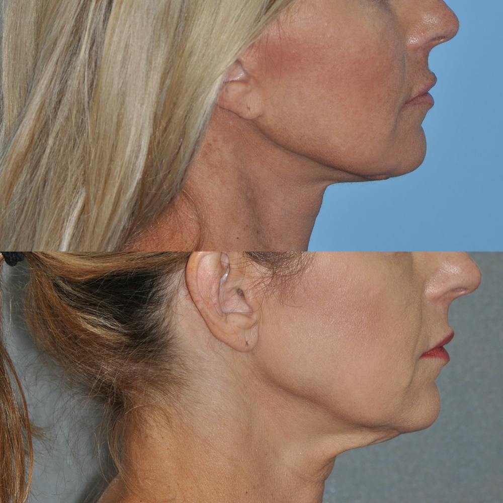 Facelift Before & After Gallery - Patient 59047940 - Image 2